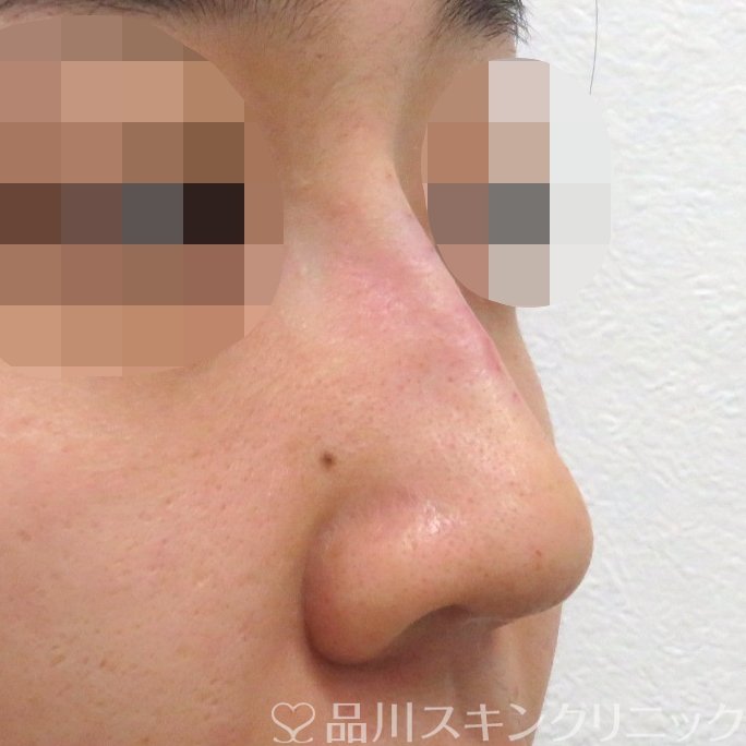 症例NO.66957のAFTER写真