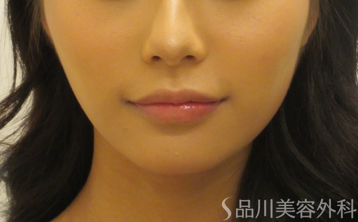 症例NO.71689のBEFORE写真