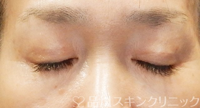 症例NO.65457のAFTER写真