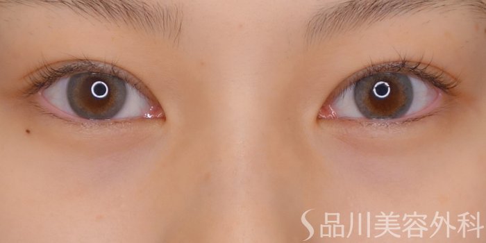 症例NO.69651のAFTER写真