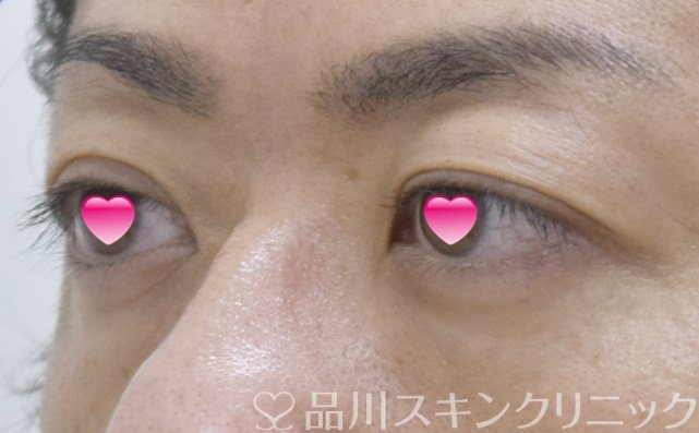 症例NO.62309のBEFORE写真