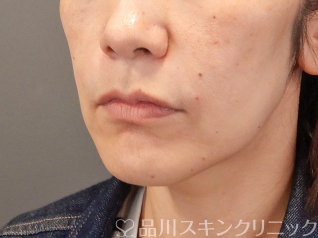症例NO.75087のAFTER写真