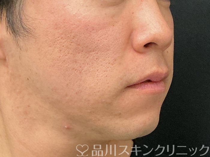 症例NO.74786のBEFORE写真