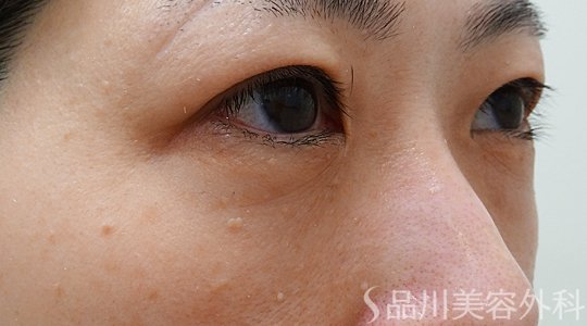 症例NO.73438のAFTER写真