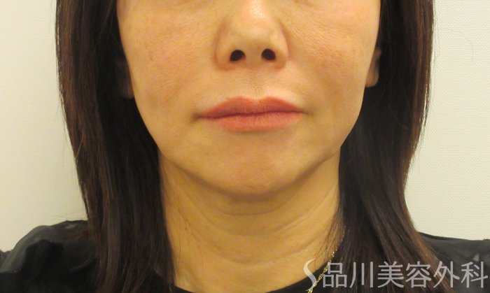 症例NO.73083のAFTER写真