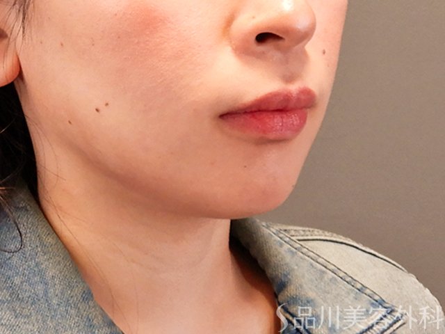 症例NO.69954のBEFORE写真