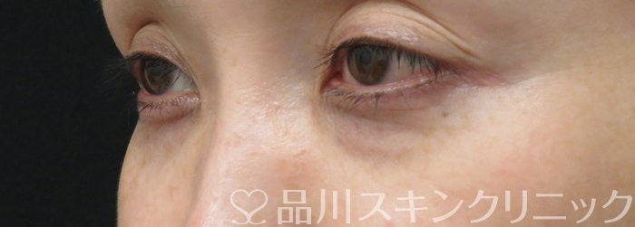 症例NO.74737のBEFORE写真
