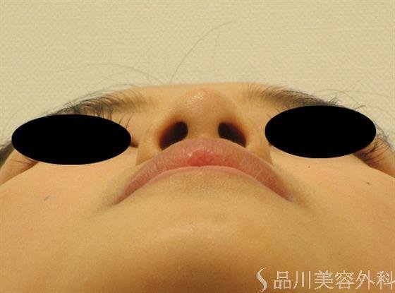 症例NO.48553のAFTER写真