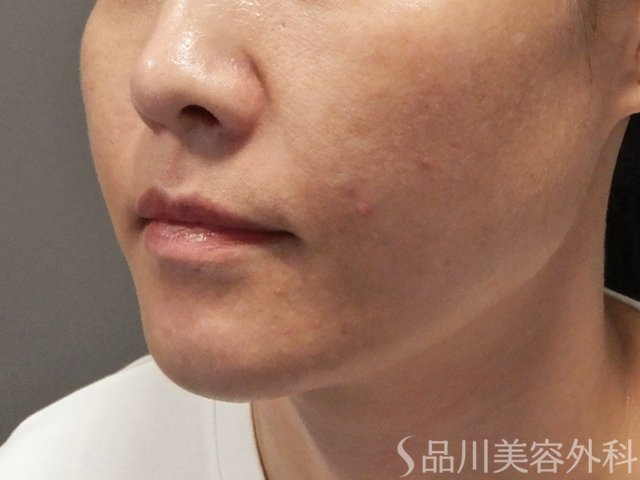 症例NO.71830のBEFORE写真