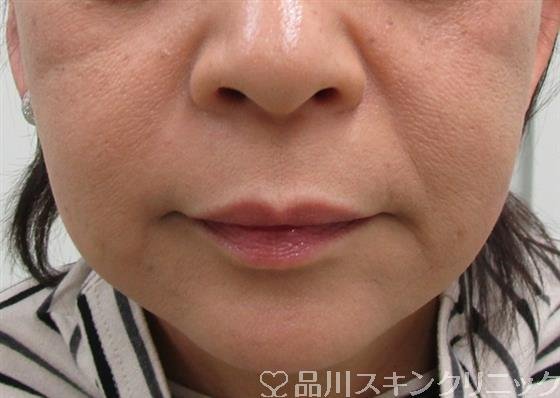 症例NO.34501のBEFORE写真