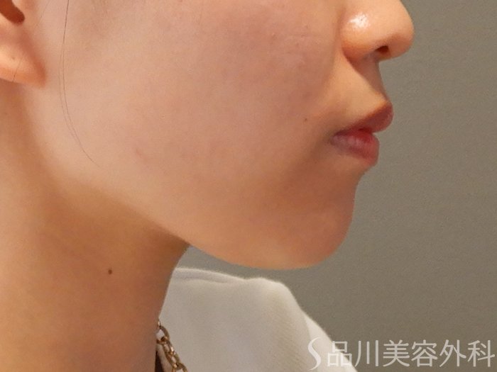 症例NO.70567のBEFORE写真