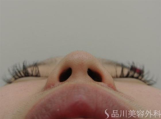 症例NO.16017のAFTER写真