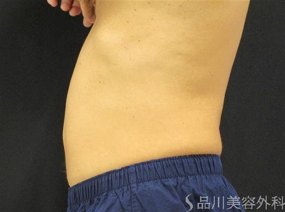 症例NO.50910のBEFORE写真