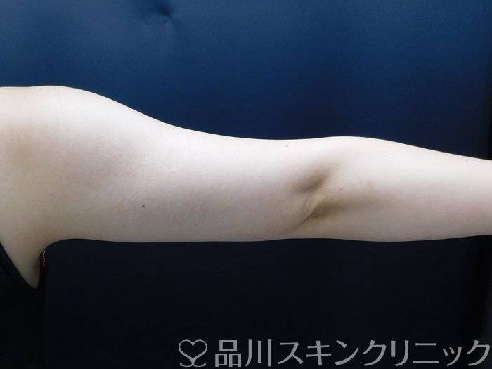 症例NO.65614のAFTER写真