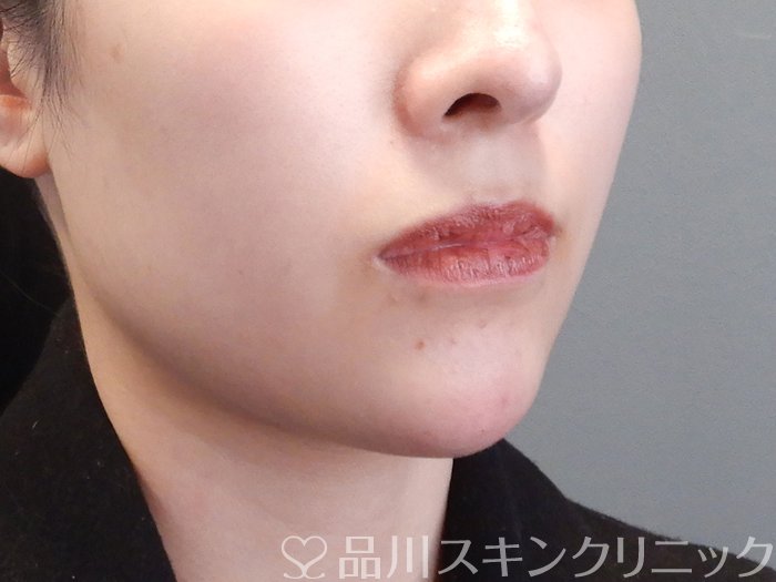 症例NO.72980のAFTER写真