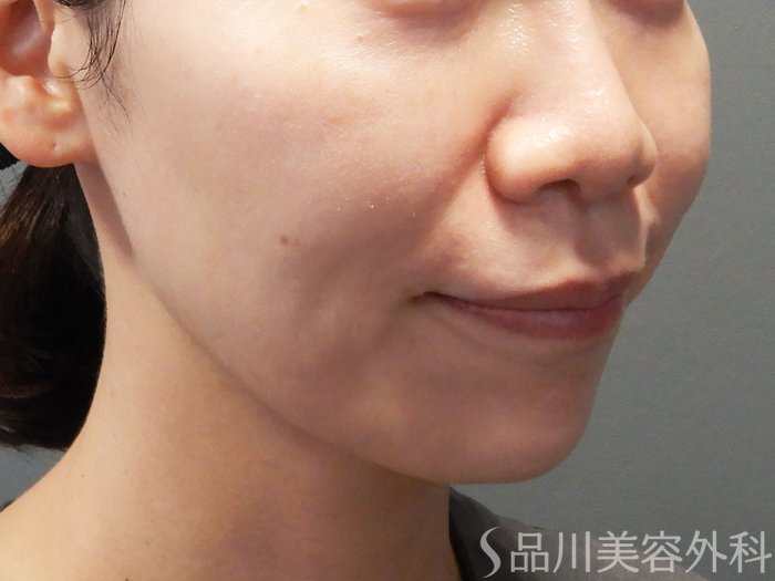 症例NO.70425のBEFORE写真