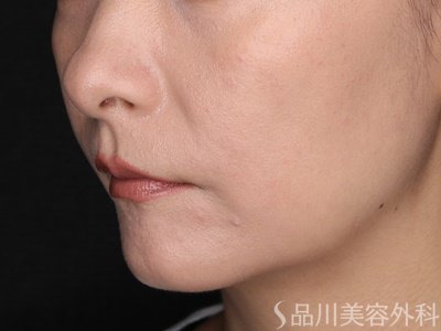 症例NO.74513のAFTER写真
