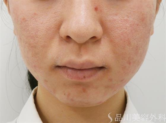 症例NO.30674のBEFORE写真