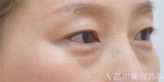 症例NO.61228のBEFORE写真