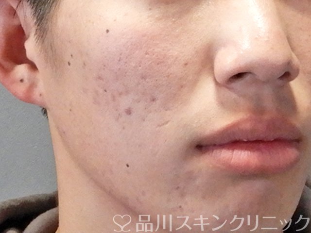 症例NO.68896のAFTER写真