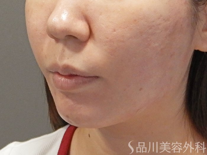 症例NO.71340のAFTER写真