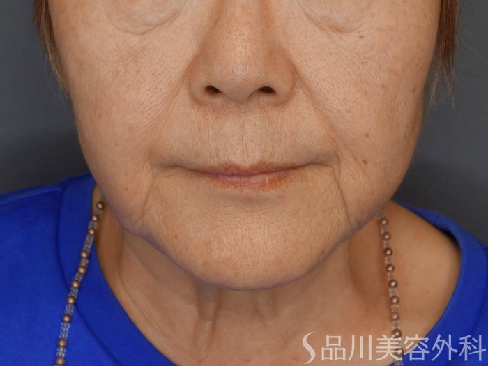 症例NO.71772のBEFORE写真