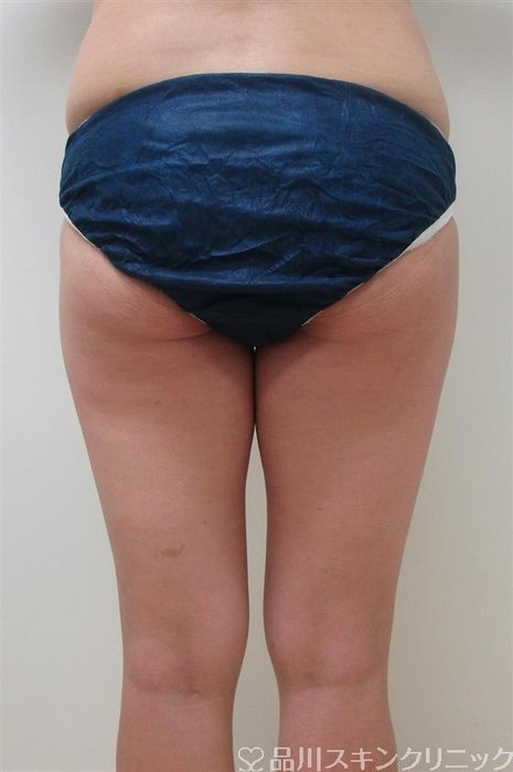 症例NO.29963のBEFORE写真