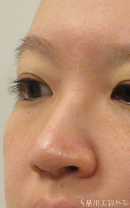 症例NO.70727のBEFORE写真