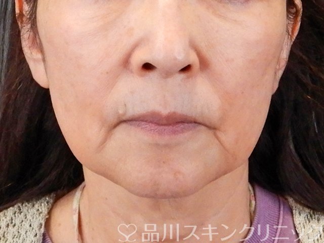 症例NO.75299のBEFORE写真