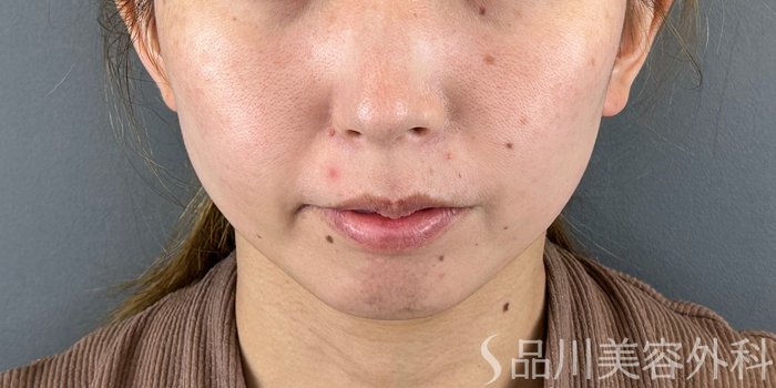 症例NO.71961のBEFORE写真