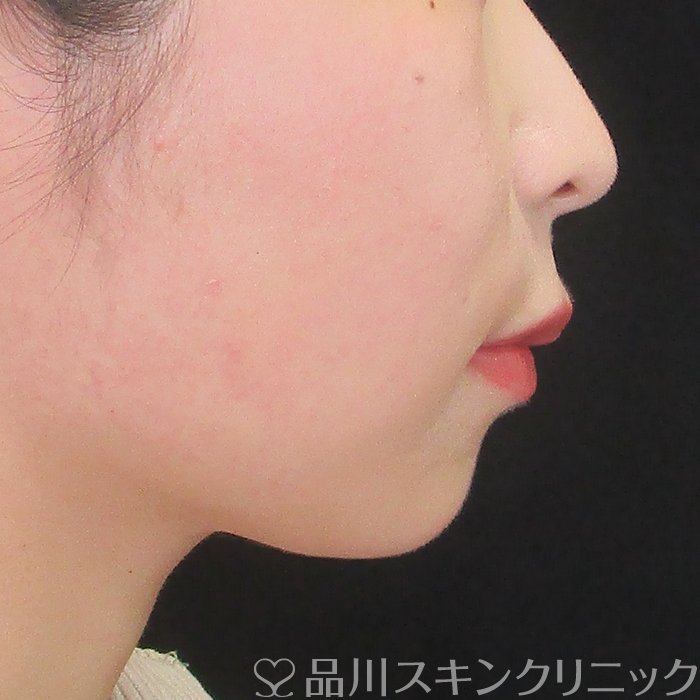 症例NO.75325のBEFORE写真