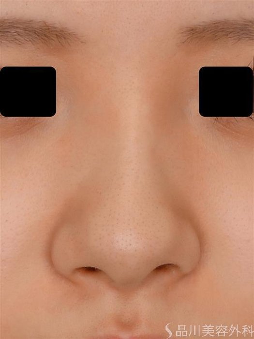 症例NO.55012のBEFORE写真