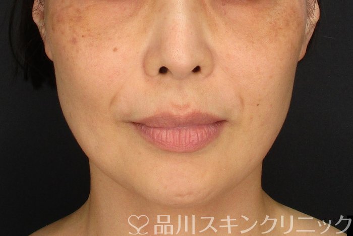 症例NO.72822のBEFORE写真