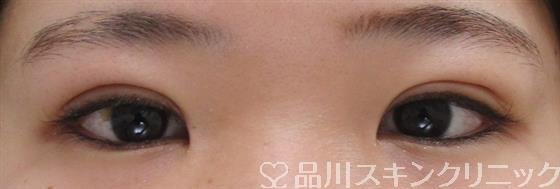 症例NO.41630のAFTER写真