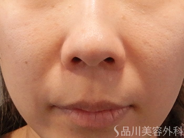症例NO.70517のBEFORE写真