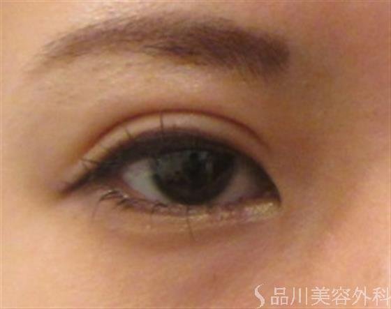 症例NO.23393のAFTER写真