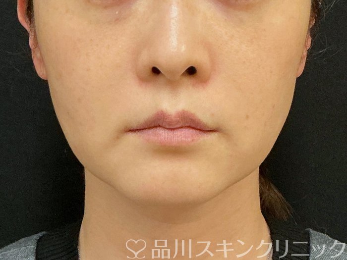 症例NO.74300のBEFORE写真