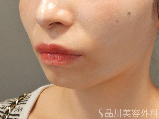 症例NO.71674のBEFORE写真