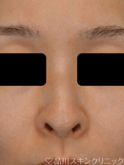 症例NO.73745のBEFORE写真