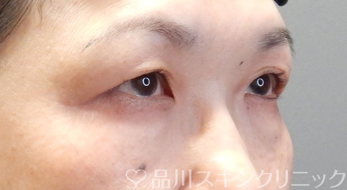 症例NO.72128のBEFORE写真