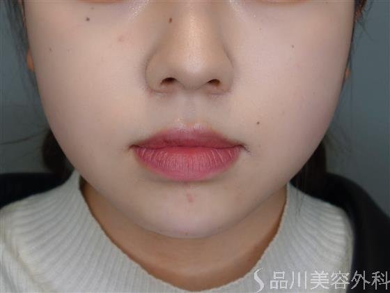 症例NO.51001のAFTER写真