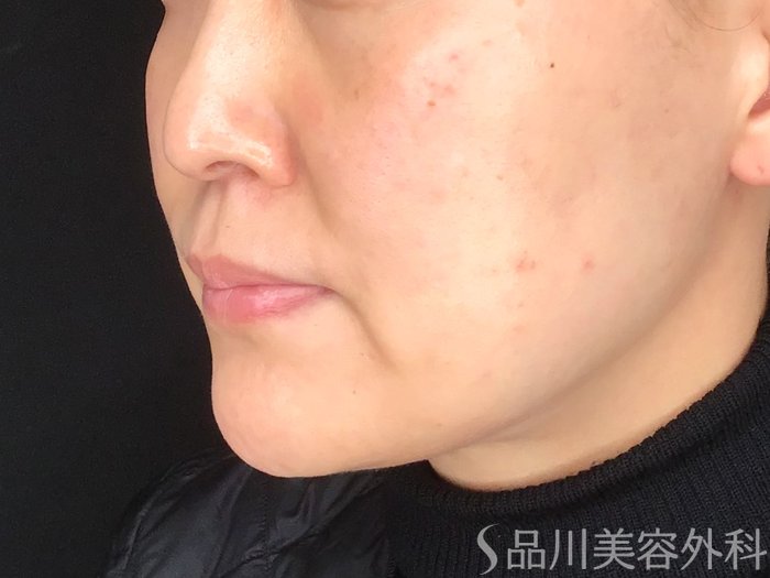 症例NO.64785のBEFORE写真