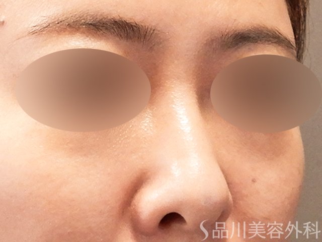 症例NO.69627のBEFORE写真
