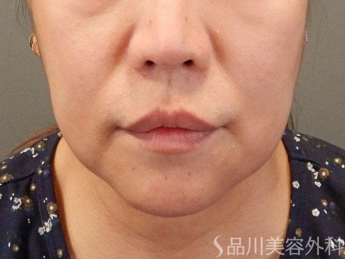 症例NO.67763のBEFORE写真