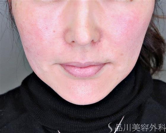 症例NO.49342のBEFORE写真
