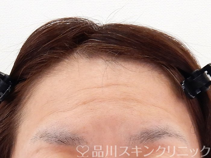 症例NO.62192のBEFORE写真
