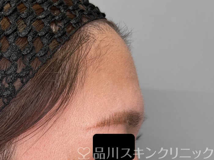 症例NO.70091のBEFORE写真