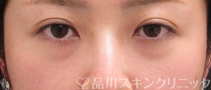 症例NO.63713のBEFORE写真