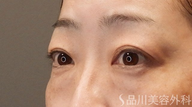 症例NO.75229のBEFORE写真