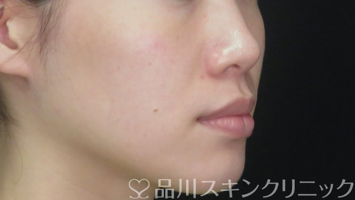症例NO.71557のBEFORE写真